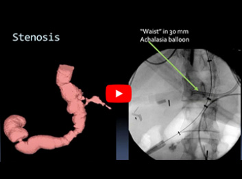 XV IFSO / IV IFSO APC Webinar