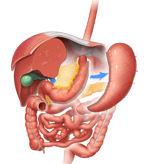 Painful Bloating After Bariatric Surgery - Mexico Bariatric Center